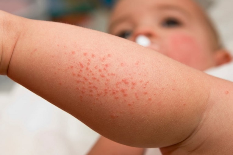 Alergia na Pele – Remédios Naturais