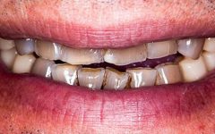 Envelhecimento Precoce dos Dentes – Como Evitar