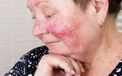 Alergia ao Frio – Causas e Sintomas