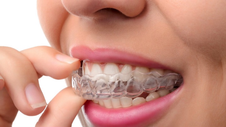 Aparelho Invisível Nos Dentes – Tratamento