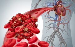 Embolia Arterial – Causas e Sintomas