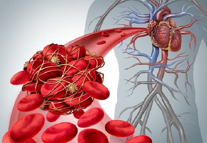 Embolia Arterial – Causas e Sintomas